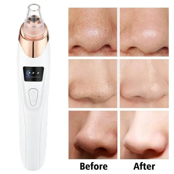 5 in 1 Rechargeable Blackhead Remover