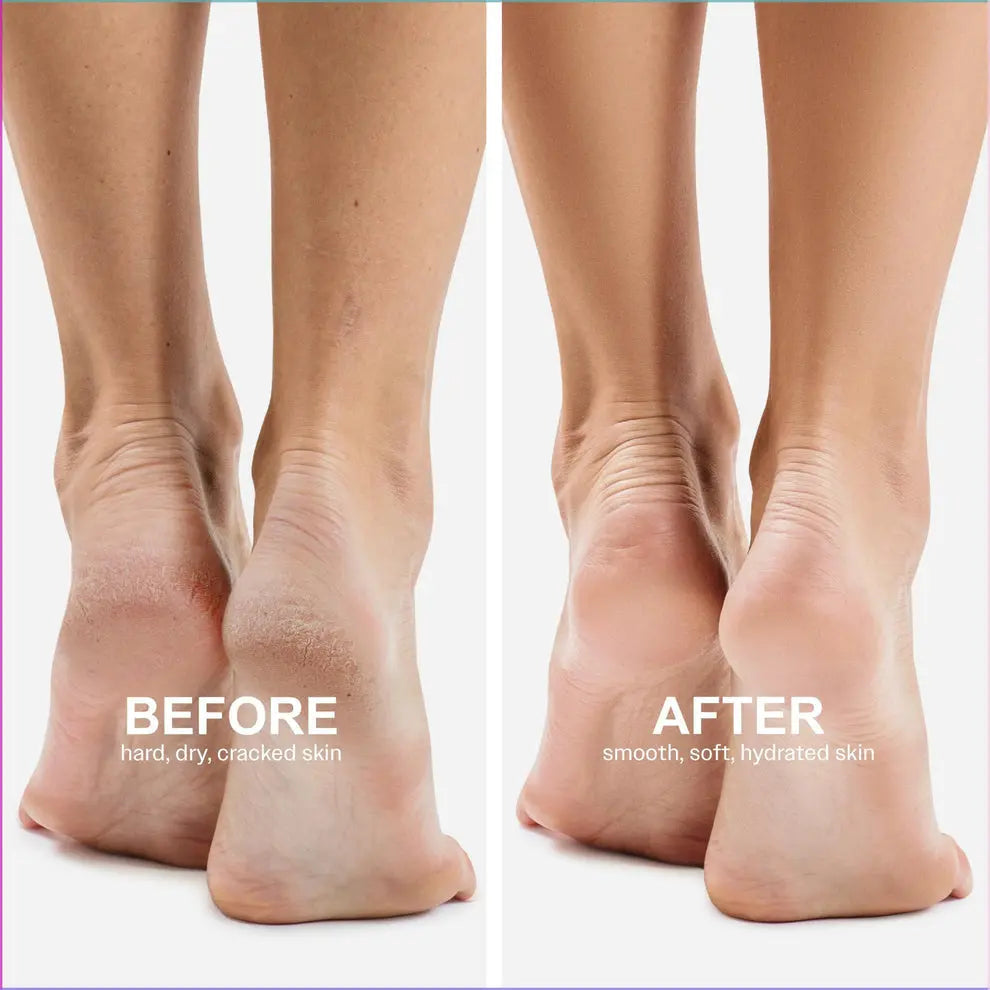 Electric Dead Skin Remover