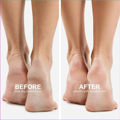 Electric Dead Skin Remover